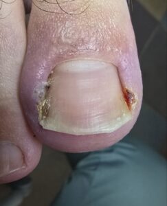 вросший ноготь_киев