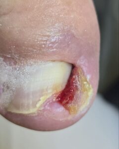 вростает ноготь