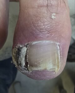 запущеный вросший ноготь