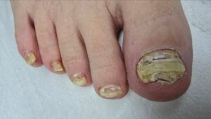 пораженные грибком ногти на ногах