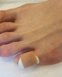 мозоль мізинця на нозі. разгрузка