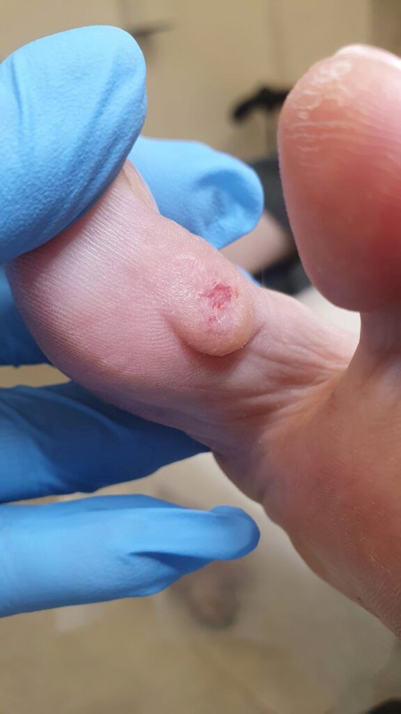мозоль при Hallux Valgus