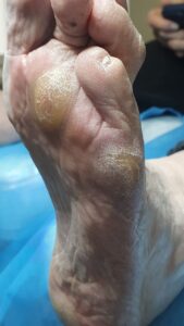 мозоль в зоні плесневих кісток