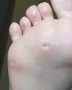 мозоль від неправильного взуття. оброблена