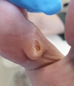 сильный мозоль между пальцев