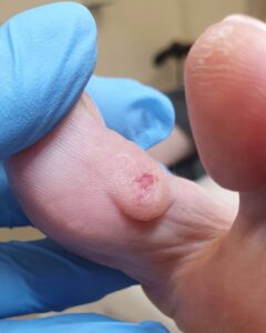 сильный мозоль между пальцев_обработанный