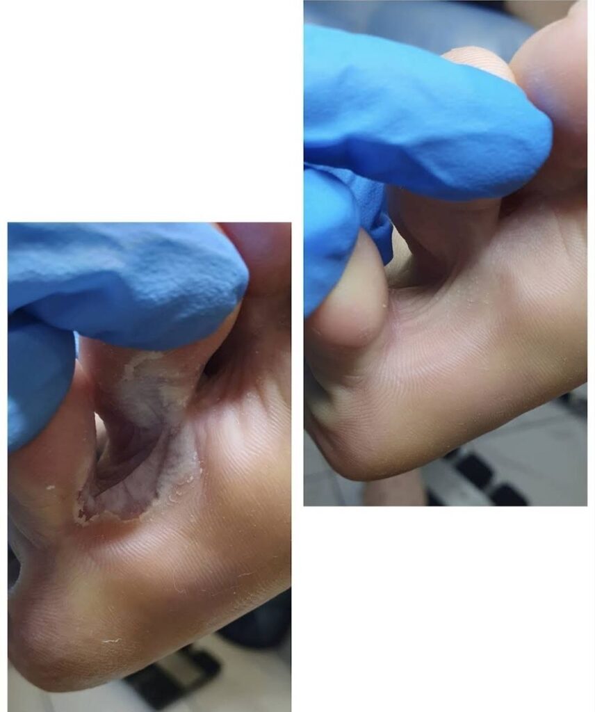 лечение грибка между пальцами