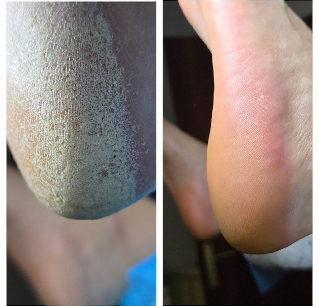 лечение грибка стоп