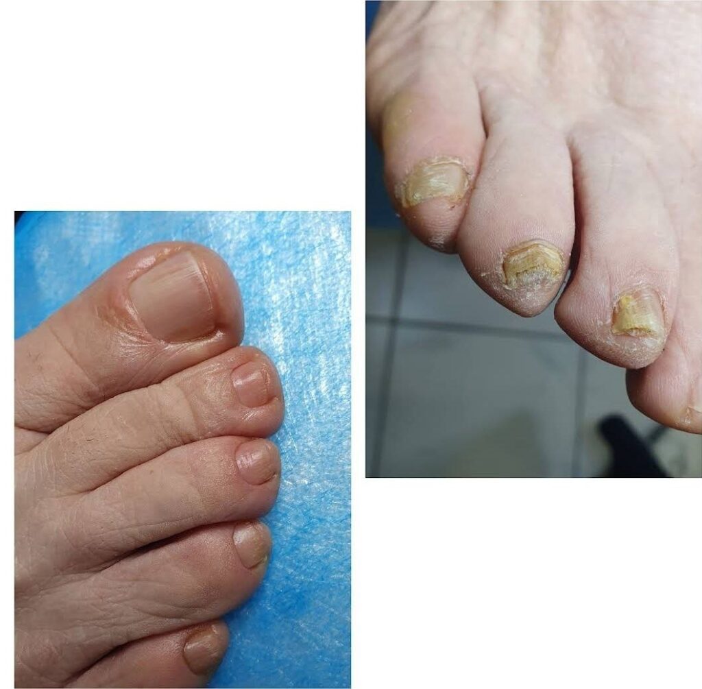 Лечение грибка у подолога