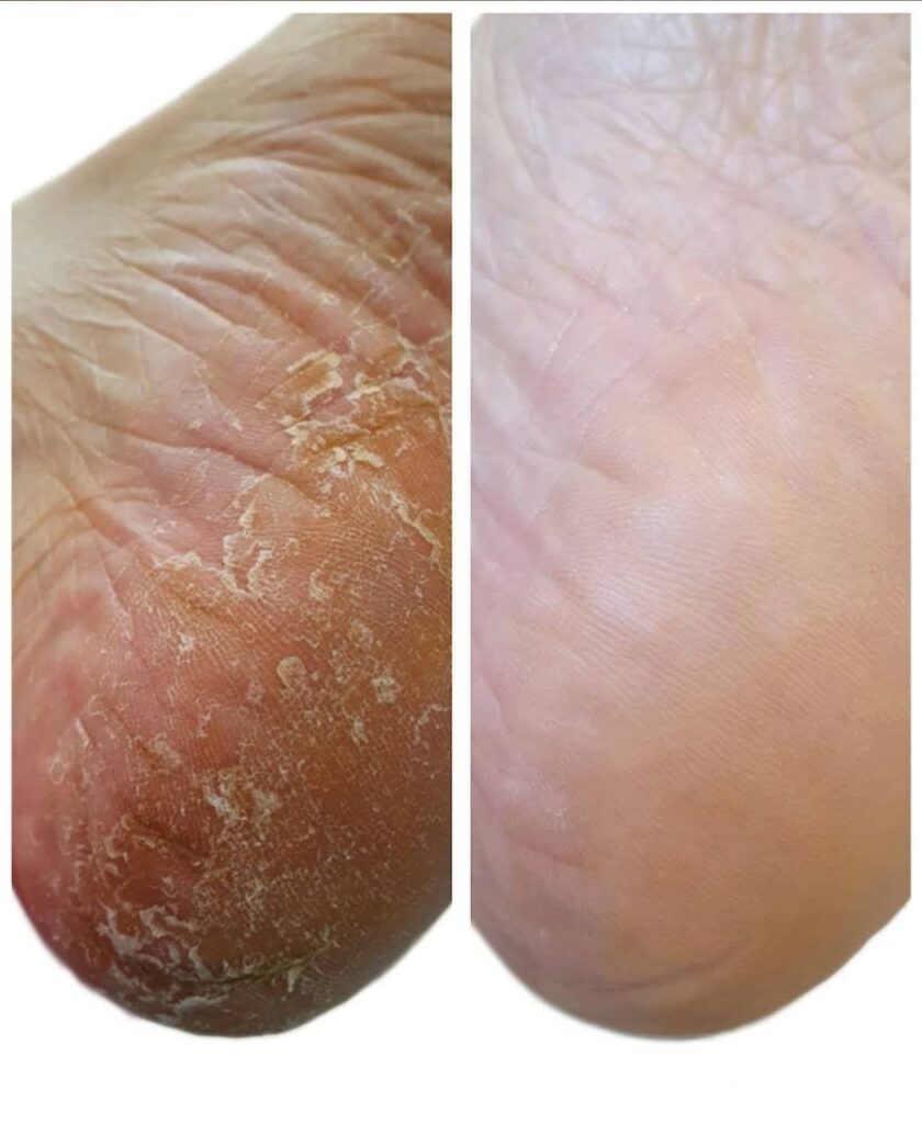 подологическая обработка кожи стопы от грибка