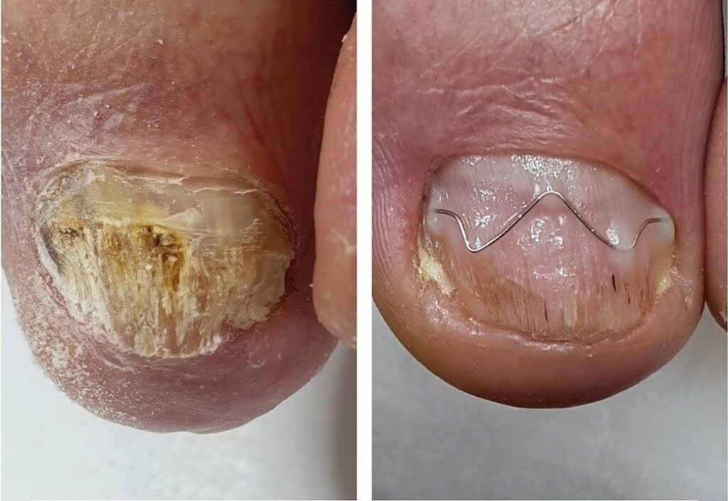 подологическая обработка ногтя от грибка